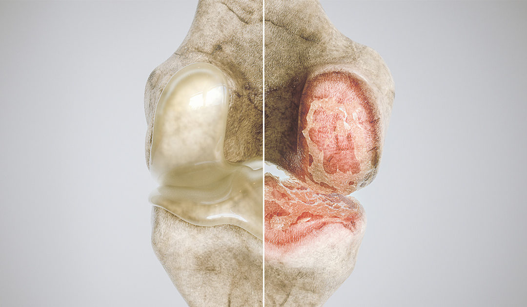 Osteoarthritis Osteoporosis Osteopenia