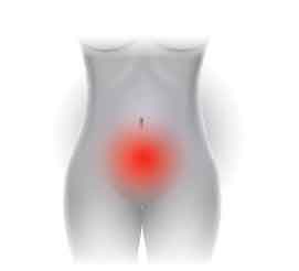 Endometriosis   Higher Risk of Stroke?